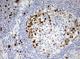 TOP2A / Topoisomerase II Alpha Antibody - IHC of paraffin-embedded Carcinoma of Human bladder tissue using anti-TOP2A mouse monoclonal antibody. (Heat-induced epitope retrieval by 10mM citric buffer, pH6.0, 120°C for 3min).