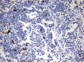 TOP2A / Topoisomerase II Alpha Antibody - IHC of paraffin-embedded Human lymphoma tissue using anti-TOP2A mouse monoclonal antibody. (Heat-induced epitope retrieval by 10mM citric buffer, pH6.0, 120°C for 3min).