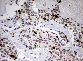 TOP2A / Topoisomerase II Alpha Antibody - IHC of paraffin-embedded Adenocarcinoma of Human breast tissue using anti-TOP2A mouse monoclonal antibody. (Heat-induced epitope retrieval by 10mM citric buffer, pH6.0, 120°C for 3min).