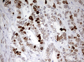 TOP2A / Topoisomerase II Alpha Antibody - IHC of paraffin-embedded Adenocarcinoma of Human colon tissue using anti-TOP2A mouse monoclonal antibody. (Heat-induced epitope retrieval by 10mM citric buffer, pH6.0, 120°C for 3min).