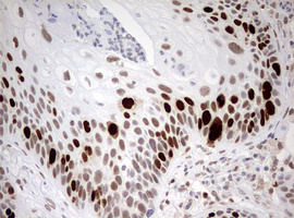 TOP2A / Topoisomerase II Alpha Antibody - IHC of paraffin-embedded Carcinoma of Human lung tissue using anti-TOP2A mouse monoclonal antibody. (Heat-induced epitope retrieval by 10mM citric buffer, pH6.0, 120°C for 3min).