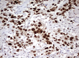 TOP2A / Topoisomerase II Alpha Antibody - IHC of paraffin-embedded Adenocarcinoma of Human ovary tissue using anti-TOP2A mouse monoclonal antibody. (Heat-induced epitope retrieval by 10mM citric buffer, pH6.0, 120°C for 3min).