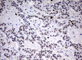 TOP2A / Topoisomerase II Alpha Antibody - IHC of paraffin-embedded Carcinoma of Human pancreas tissue using anti-TOP2A mouse monoclonal antibody. (Heat-induced epitope retrieval by 10mM citric buffer, pH6.0, 120°C for 3min).