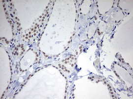 TOP2A / Topoisomerase II Alpha Antibody - IHC of paraffin-embedded Human thyroid tissue using anti-TOP2A mouse monoclonal antibody. (Heat-induced epitope retrieval by 10mM citric buffer, pH6.0, 120°C for 3min).