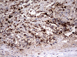 TOP2A / Topoisomerase II Alpha Antibody - IHC of paraffin-embedded Adenocarcinoma of Human endometrium tissue using anti-TOP2A mouse monoclonal antibody. (Heat-induced epitope retrieval by 10mM citric buffer, pH6.0, 120°C for 3min).