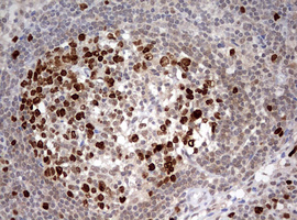 TOP2A / Topoisomerase II Alpha Antibody - IHC of paraffin-embedded Carcinoma of Human bladder tissue using anti-TOP2A mouse monoclonal antibody. (Heat-induced epitope retrieval by 10mM citric buffer, pH6.0, 120°C for 3min).