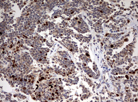 TOP2A / Topoisomerase II Alpha Antibody - IHC of paraffin-embedded Human lymphoma tissue using anti-TOP2A mouse monoclonal antibody. (Heat-induced epitope retrieval by 10mM citric buffer, pH6.0, 120°C for 3min).