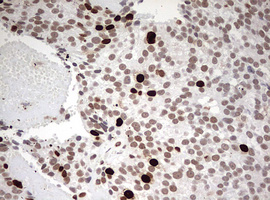TOP2A / Topoisomerase II Alpha Antibody - IHC of paraffin-embedded Adenocarcinoma of Human breast tissue using anti-TOP2A mouse monoclonal antibody. (Heat-induced epitope retrieval by 1 mM EDTA in 10mM Tris, pH9.0, 120°C for 3min).