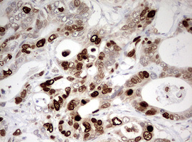 TOP2A / Topoisomerase II Alpha Antibody - IHC of paraffin-embedded Adenocarcinoma of Human colon tissue using anti-TOP2A mouse monoclonal antibody. (Heat-induced epitope retrieval by 1 mM EDTA in 10mM Tris, pH9.0, 120°C for 3min).