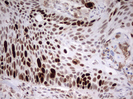 TOP2A / Topoisomerase II Alpha Antibody - IHC of paraffin-embedded Carcinoma of Human lung tissue using anti-TOP2A mouse monoclonal antibody. (Heat-induced epitope retrieval by 1 mM EDTA in 10mM Tris, pH9.0, 120°C for 3min).