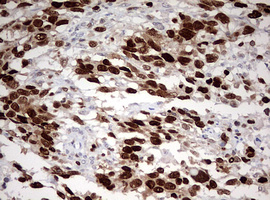 TOP2A / Topoisomerase II Alpha Antibody - IHC of paraffin-embedded Adenocarcinoma of Human ovary tissue using anti-TOP2A mouse monoclonal antibody. (Heat-induced epitope retrieval by 1 mM EDTA in 10mM Tris, pH9.0, 120°C for 3min).