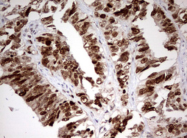 TOP2A / Topoisomerase II Alpha Antibody - IHC of paraffin-embedded Adenocarcinoma of Human endometrium tissue using anti-TOP2A mouse monoclonal antibody. (Heat-induced epitope retrieval by 1 mM EDTA in 10mM Tris, pH9.0, 120°C for 3min).