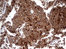 TOP2A / Topoisomerase II Alpha Antibody - IHC of paraffin-embedded Human lymphoma tissue using anti-TOP2A mouse monoclonal antibody. (Heat-induced epitope retrieval by 1 mM EDTA in 10mM Tris, pH9.0, 120°C for 3min).