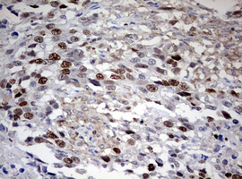 TOP2A / Topoisomerase II Alpha Antibody - IHC of paraffin-embedded Adenocarcinoma of Human ovary tissue using anti-TOP2A mouse monoclonal antibody. (Heat-induced epitope retrieval by 10mM citric buffer, pH6.0, 120°C for 3min).