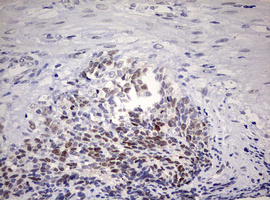 TOP2A / Topoisomerase II Alpha Antibody - IHC of paraffin-embedded Adenocarcinoma of Human endometrium tissue using anti-TOP2A mouse monoclonal antibody. (Heat-induced epitope retrieval by 10mM citric buffer, pH6.0, 120°C for 3min).