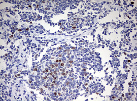 TOP2A / Topoisomerase II Alpha Antibody - IHC of paraffin-embedded Human lymphoma tissue using anti-TOP2A mouse monoclonal antibody. (Heat-induced epitope retrieval by 10mM citric buffer, pH6.0, 120°C for 3min).