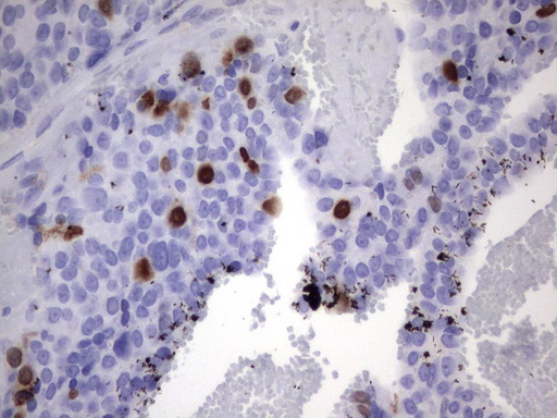 TOP2A / Topoisomerase II Alpha Antibody - Immunohistochemical staining of paraffin-embedded Adenocarcinoma of Human breast tissue using anti-TOP2A mouse monoclonal antibody.  heat-induced epitope retrieval by 1 mM EDTA in 10mM Tris, pH8.0, 120C for 3min)