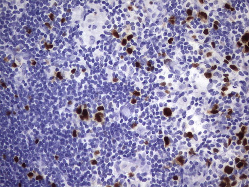 TOP2A / Topoisomerase II Alpha Antibody - Immunohistochemical staining of paraffin-embedded Human lymphoma tissue using anti-TOP2A mouse monoclonal antibody.  heat-induced epitope retrieval by 1 mM EDTA in 10mM Tris, pH8.0, 120C for 3min)