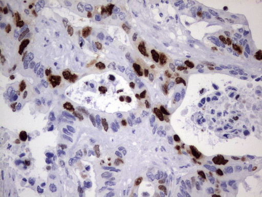 TOP2A / Topoisomerase II Alpha Antibody - Immunohistochemical staining of paraffin-embedded Adenocarcinoma of Human colon tissue using anti-TOP2A mouse monoclonal antibody.  heat-induced epitope retrieval by 1 mM EDTA in 10mM Tris, pH8.0, 120C for 3min)