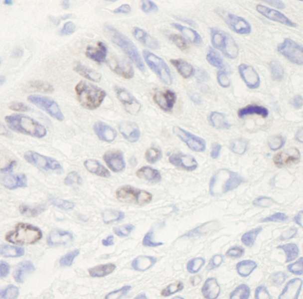 TOP2A / Topoisomerase II Alpha Antibody - Detection of Human Topo II Alpha by Immunohistochemistry. Sample: FFPE section of human larynx squamous cell carcinoma. Antibody: Affinity purified rabbit anti-Topo II Alpha used at a dilution of 1:250. Detection: DAB staining using anti-Rabbit IHC antibody at a dilution of 1:100.