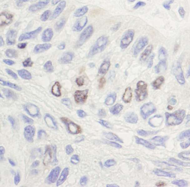 TOP2A / Topoisomerase II Alpha Antibody - Detection of Human Topo II Alpha by Immunohistochemistry. Sample: FFPE section of human laryngeal squamous cell carcinoma. Antibody: Affinity purified rabbit anti-Topo II alpha used at a dilution of 1:1000 (1 ug/ml). Detection: DAB.