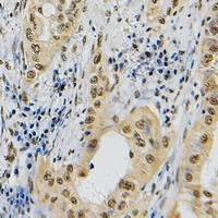 TOP2A / Topoisomerase II Alpha Antibody - Immunohistochemical analysis of Topoisomerase 2 alpha staining in human lung cancer formalin fixed paraffin embedded tissue section. The section was pre-treated using heat mediated antigen retrieval with sodium citrate buffer (pH 6.0). The section was then incubated with the antibody at room temperature and detected with HRP and DAB as chromogen. The section was then counterstained with hematoxylin and mounted with DPX.