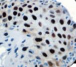 TOP2A / Topoisomerase II Alpha Antibody - IHC of Topo IIa on FFPE HSIL of the Cervix.