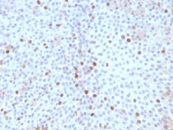 TOP2A / Topoisomerase II Alpha Antibody - IHC testing of FFPE human bladder carcinoma with Topoisomerase II alpha antibody (clone TOP2A/1361). Required HIER: boil sections in 10mM citrate buffer, pH6, for 10-20 min followed by cooling at RT for 20 min.