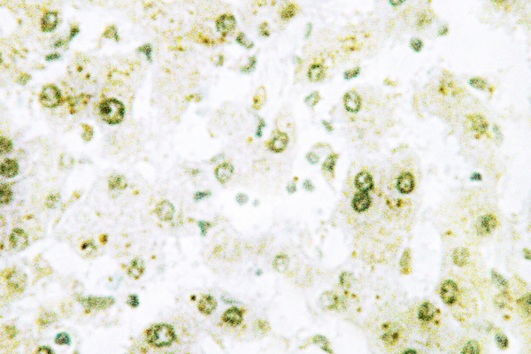 TOP2A / Topoisomerase II Alpha Antibody - IHC of Topo II (Q14) pAb in paraffin-embedded human liver carcinoma tissue.