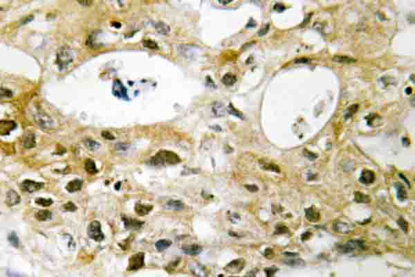 TOP2A / Topoisomerase II Alpha Antibody - IHC of Topo II (E1102) pAb in paraffin-embedded human breast carcinoma tissue.
