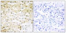 TOP2A / Topoisomerase II Alpha Antibody - Peptide - + Immunohistochemistry analysis of paraffin-embedded human liver carcinoma tissue using TOP2A antibody.