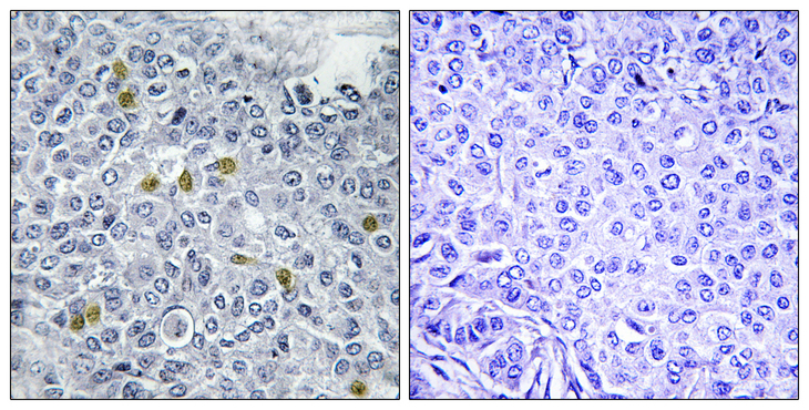 TOP2A / Topoisomerase II Alpha Antibody - Immunohistochemistry analysis of paraffin-embedded human breast carcinoma, using TOP2A (Phospho-Ser1106) Antibody. The picture on the right is blocked with the phospho peptide.