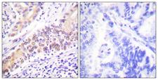 TOP2B / Topoisomerase II Beta Antibody - Immunohistochemistry analysis of paraffin-embedded human lung carcinoma tissue, using TOP2B Antibody. The picture on the right is blocked with the synthesized peptide.