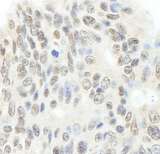 TOP2B / Topoisomerase II Beta Antibody - Detection of Human Topo II Beta by Immunohistochemistry. Sample: FFPE section of human ovarian carcinoma. Antibody: Affinity purified rabbit anti-Topo II Beta used at a dilution of 1:200 (1 ug/ml). Detection: DAB.
