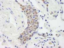 TOP2B / Topoisomerase II Beta Antibody - Detection of Human Topo II Beta by Immunohistochemistry. Sample: FFPE section of human small cell lung cancer. Antibody: Affinity purified rabbit anti-Topo II Beta used at a dilution of 1:250.