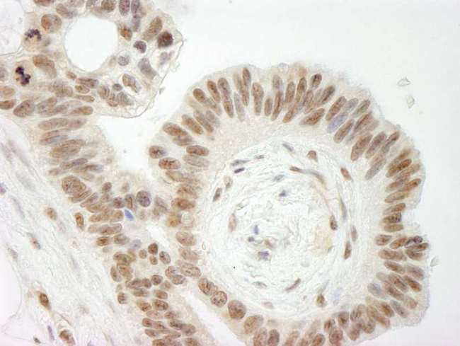 TOP2B / Topoisomerase II Beta Antibody - Detection of Human Topo II Beta by Immunohistochemistry. Sample: FFPE section of human ovarian cancer. Antibody: Affinity purified rabbit anti-Topo II Beta used at a dilution of 1:250.