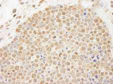 TOP2B / Topoisomerase II Beta Antibody - Detection of Human Topo II Beta by Immunohistochemistry. Sample: FFPE section of human small cell lung cancer. Antibody: Affinity purified rabbit anti-Topo II Beta used at a dilution of 1:200 (1 ug/ml). Detection: DAB.