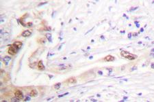 TOP2B / Topoisomerase II Beta Antibody - IHC of Topoisomerase II (A32) pAb in paraffin-embedded human lung carcinoma tissue.
