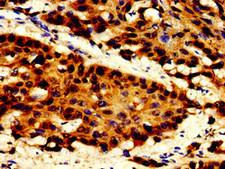 TOP2B / Topoisomerase II Beta Antibody - Immunohistochemistry image of paraffin-embedded human cervical cancer at a dilution of 1:100