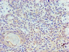 TOPBP1 Antibody - Immunohistochemistry of paraffin-embedded human breast cancer using antibody at 1:100 dilution.