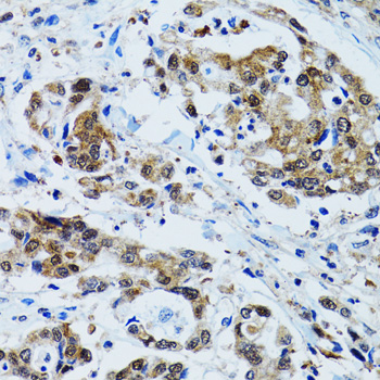 TOPBP1 Antibody - Immunohistochemistry of paraffin-embedded human colon carcinoma tissue.