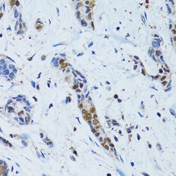 TOPBP1 Antibody - Immunohistochemistry of paraffin-embedded human breast cancer tissue.