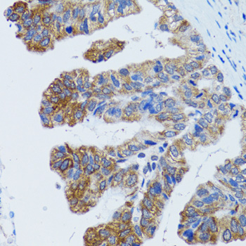 TOPBP1 Antibody - Immunohistochemistry of paraffin-embedded human gastric cancer tissue.