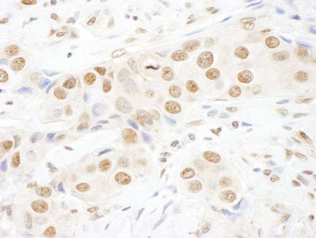 TOPORS Antibody - Detection of Human TOPORS by Immunohistochemistry. Sample: FFPE section of human breast carcinoma. Antibody: Affinity purified rabbit anti-TOPORS used at a dilution of 1:250.