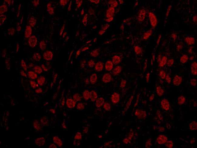 TOPORS Antibody - Detection of Human TOPORS by Immunohistochemistry. Sample: FFPE section of human breast carcinoma. Antibody: Affinity purified rabbit anti-TOPORS used at a dilution of 1:100. Detection: Red-fluorescent Goat anti-Rabbit IgG-heavy and light chain cross-adsorbed Antibody DyLight 594 Conjugated (A120-601D4) used at a dilution of 1:100.