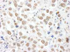 TOPORS Antibody - Detection of Human TOPORS by Immunohistochemistry. Sample: FFPE section of human testicular seminoma. Antibody: Affinity purified rabbit anti-TOPORS used at a dilution of 1:200 (1 ug/ml). Detection: DAB.