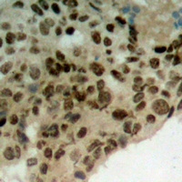 TOR1A / Torsin A Antibody - Immunohistochemical analysis of TorsinA staining in human breast cancer formalin fixed paraffin embedded tissue section. The section was pre-treated using heat mediated antigen retrieval with sodium citrate buffer (pH 6.0). The section was then incubated with the antibody at room temperature and detected using an HRP conjugated compact polymer system. DAB was used as the chromogen. The section was then counterstained with hematoxylin and mounted with DPX.