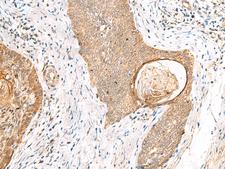 TOR1A / Torsin A Antibody - Immunohistochemistry of paraffin-embedded Human esophagus cancer tissue  using TOR1A Polyclonal Antibody at dilution of 1:35(×200)