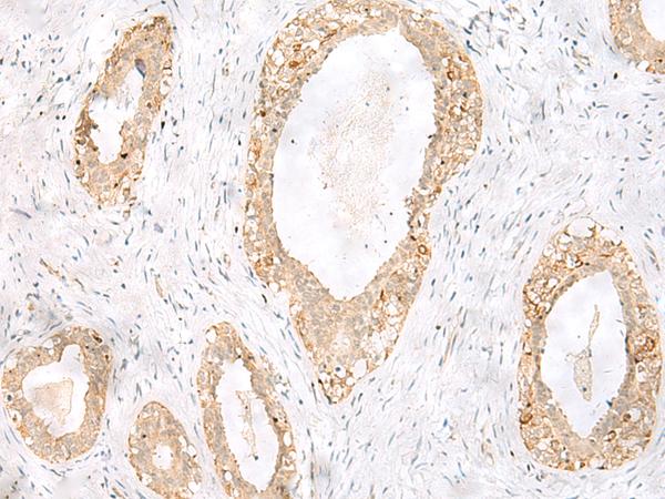 TOR1A / Torsin A Antibody - Immunohistochemistry of paraffin-embedded Human breast cancer tissue  using TOR1A Polyclonal Antibody at dilution of 1:35(×200)