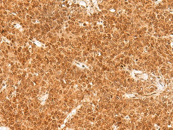 TOR1A / Torsin A Antibody - Immunohistochemistry of paraffin-embedded Human ovarian cancer tissue  using TOR1A Polyclonal Antibody at dilution of 1:30(×200)